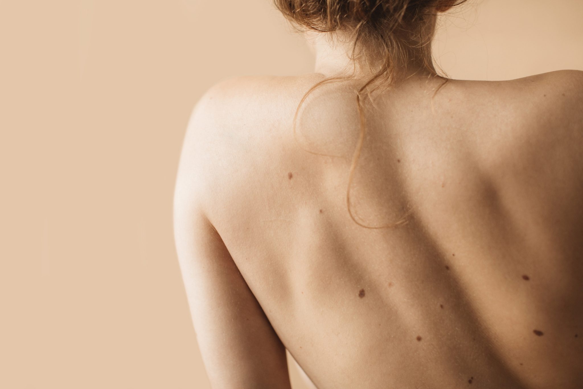 Close-up of a woman's bare back with scattered moles and loose hair against a warm beige background