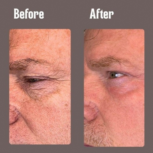 Before and after close-up of a man's eye area showing reduced wrinkles and smoother skin.
