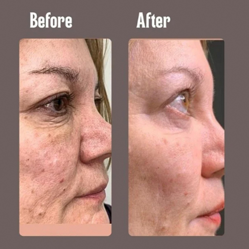 Before and after close-up of a woman's face showing reduced wrinkles and smoother skin.