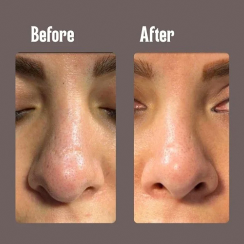 Before and after close-up of a woman's nose showing reduced blackheads, smaller pores and smoother, clearer skin.
