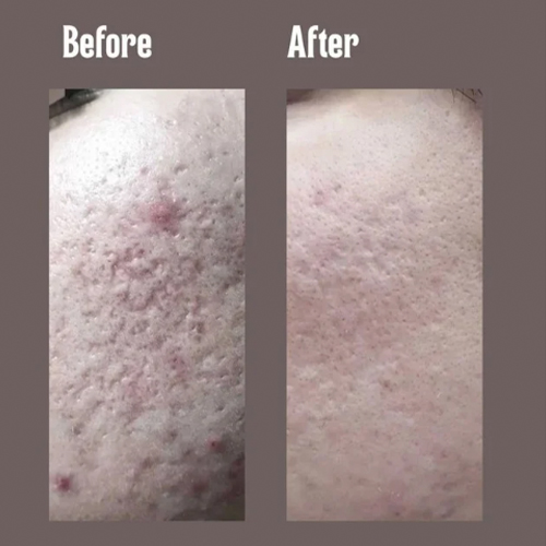 Before and after close-up of a person's facial skin showing reduced acne, redness, and smoother texture.