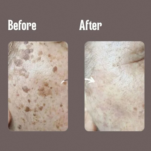 Before and after close-up of a person's cheek showing reduced dark spots and improved skin texture after treatment