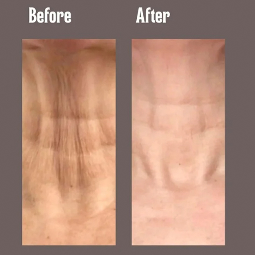 Before-and-after comparison of a woman's neck showing reduced wrinkles and smoother skin