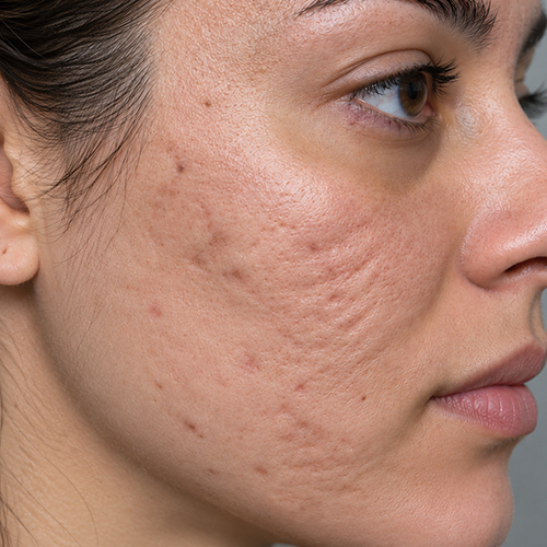 Close-up profile of a woman with acne scars and textured skin on her right cheek