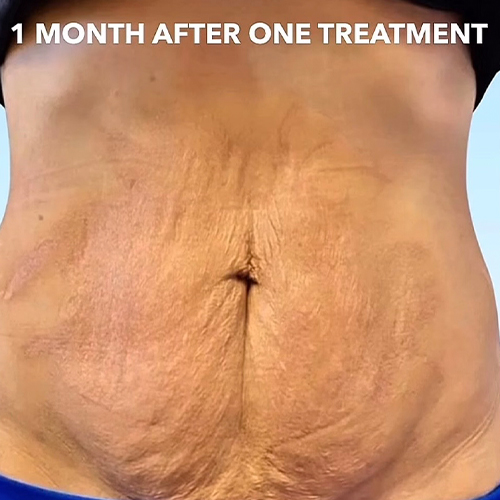 Close-up of a person's abdomen with loose skin and stretch marks, one month after treatment