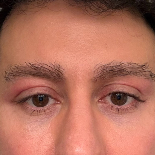 Close-up of a person's brown eyes and brows with slightly red, swollen upper eyelids
