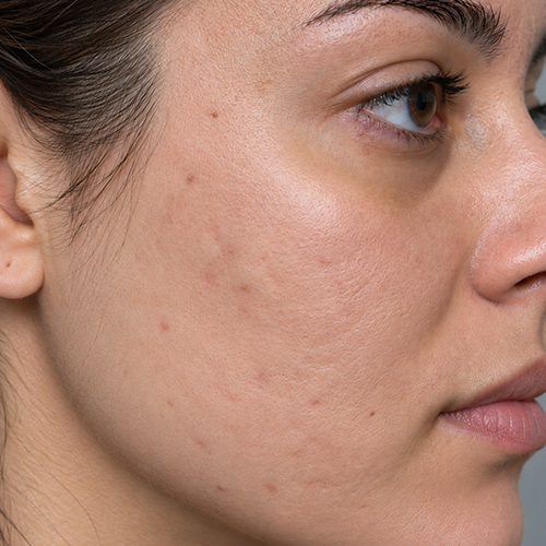 Close-up of a woman's cheek showing acne scars, textured pores, and natural skin tone.