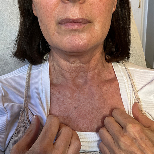 Close-up of a woman’s lower face, neck and chest with sun-damaged, wrinkled skin and age spots, hands adjusting neckline