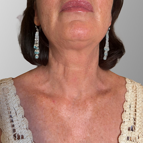 Close-up of a woman's lower face, neck and décolletage with beaded earrings and crocheted tank top showing skin texture.