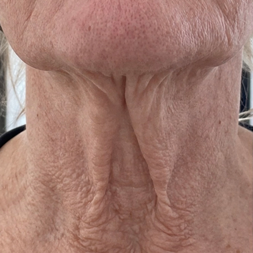 Close-up of an older woman's neck and lower face showing sagging skin, vertical neck bands and deep wrinkles.