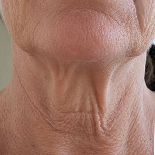 Close-up of a woman's neck and jawline with prominent wrinkles, sagging skin, and crepey texture