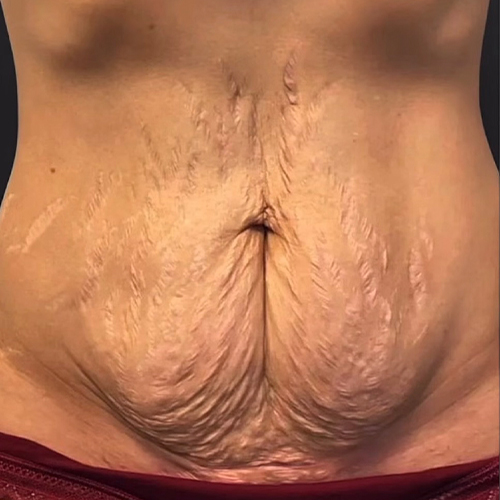 Close-up of a woman's lower abdomen showing loose, wrinkled skin and stretch marks above red underwear