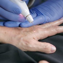Gloved clinician using handheld laser device to remove a skin lesion on the back of a person's hand.