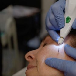 Esthetician with gloved hands using handheld needle device to perform skin treatment on a woman's cheek
