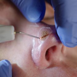 Close-up of a person's nose during dermatology treatment using electrocautery probe to remove a skin lesion