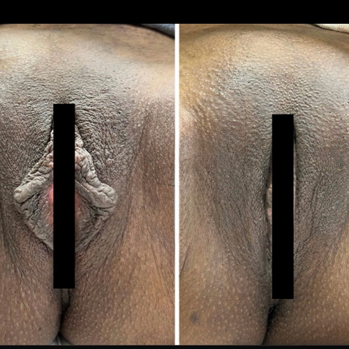 Before-and-after close-up of a woman with dark skin showing labia reduction after labiaplasty surgery.