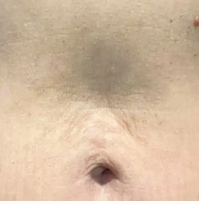 After Morpheus8 Cool treatment: abdomen skin laxity
