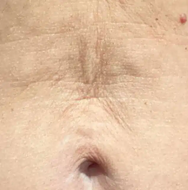 Before Morpheus8 Cool treatment: abdomen skin laxity
