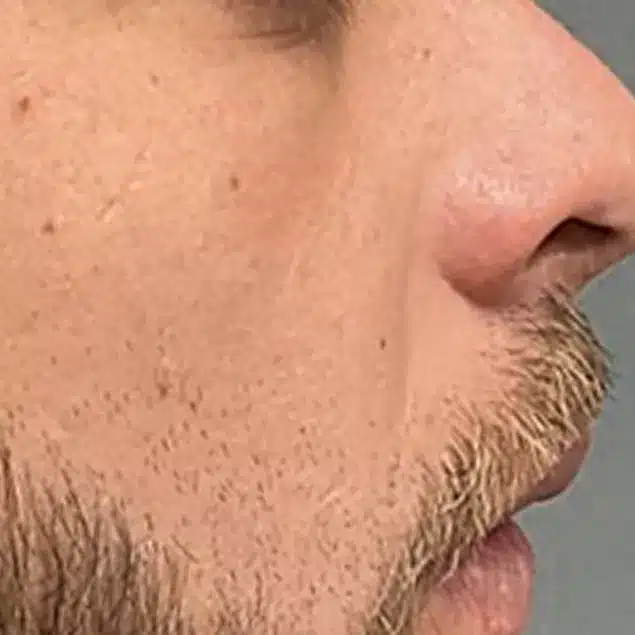 After Morpheus8 Cool treatment: cheek texture and pores