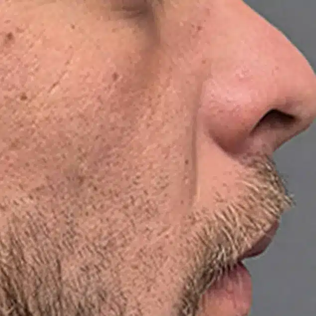 Before Morpheus8 Cool treatment: cheek texture and pores