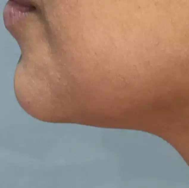 After Morpheus8 Cool treatment: under the chin and jawline