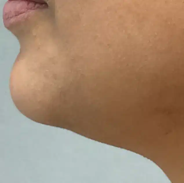 Before Morpheus8 Cool treatment: under the chin and jawline