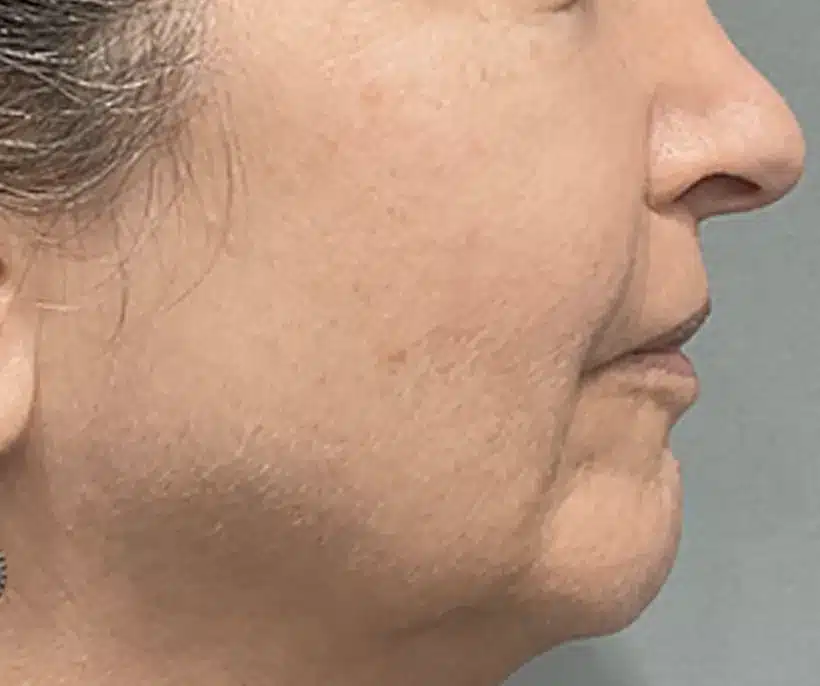After Morpheus8 Cool treatment: jowls and lower face