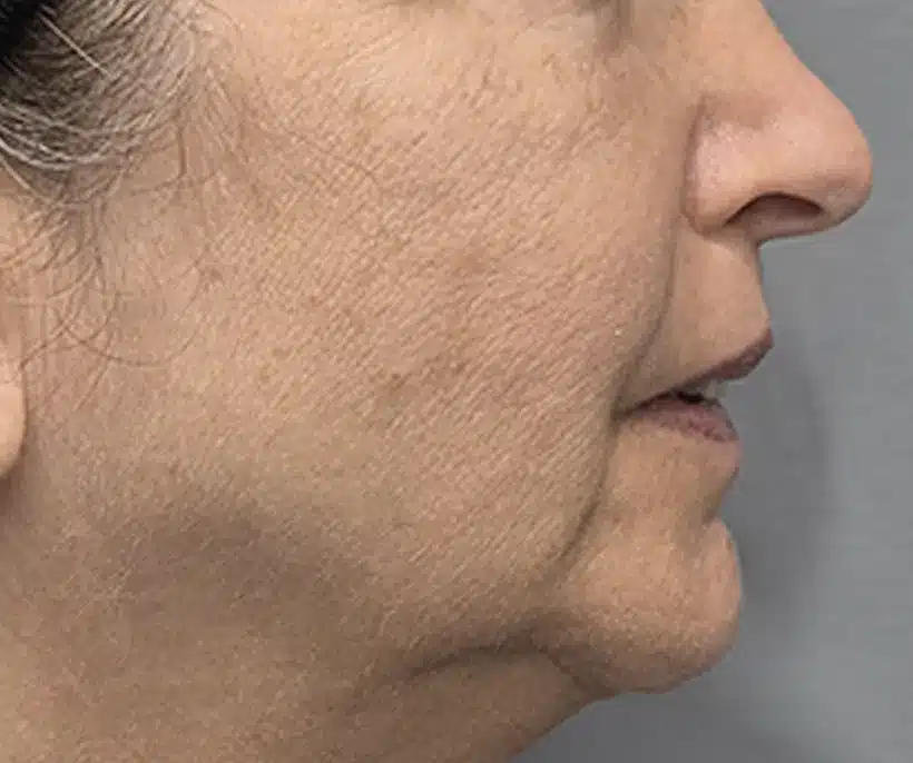 Before Morpheus8 Cool treatment: jowls and lower face