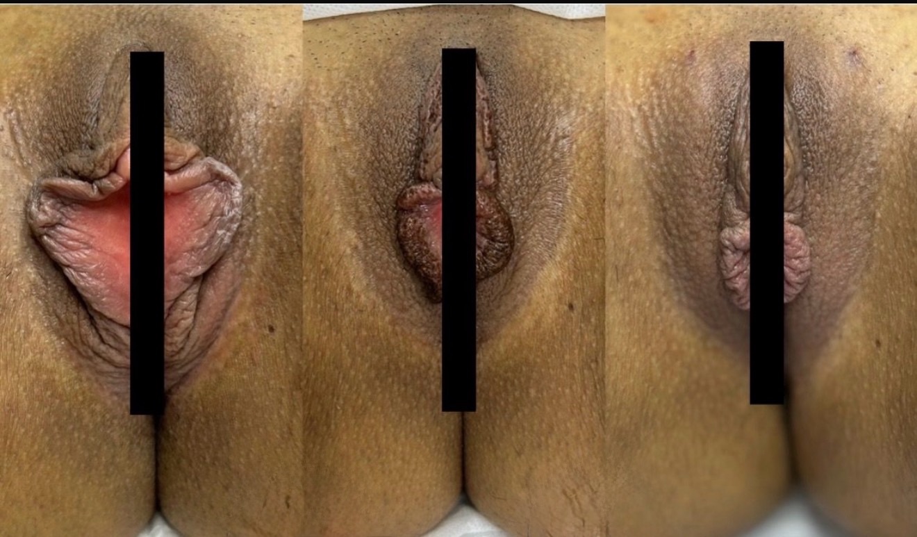 Three clinical images of a woman's vulva before, immediately after, and months after labiaplasty