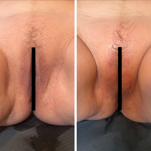Before-and-after close-up of a person's perianal area showing skin irritation and healing with censor bars.