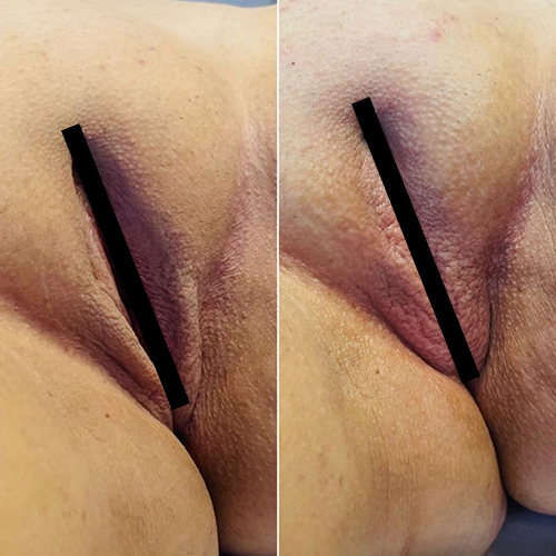 Before-and-after close-up of a person's gluteal cleft with black censor bars showing skin texture.