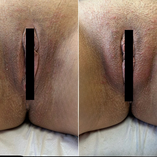 Side-by-side close-up before-and-after of a woman's vulva and perineum with black censor bars